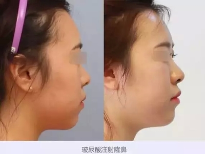 注射隆鼻效果好么