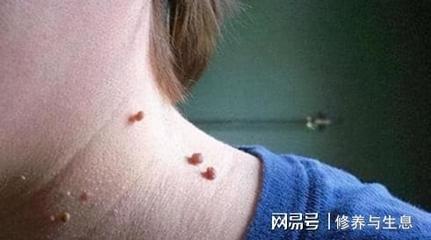 身上有扁平疣是怎么回事