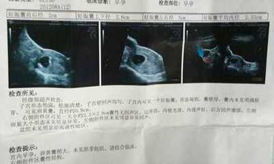 刚怀孕一周会恶心吗