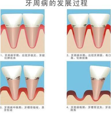 牙周炎早期怎么治疗