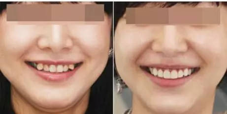 牙齿微龅如何矫正