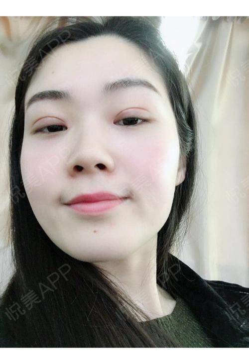 做全切双眼皮多久能化妆