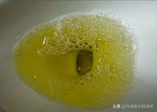小便茶色是怎么回事