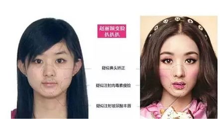 额头长痘痘能打肉毒素吗