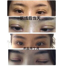 李天石双眼皮案例