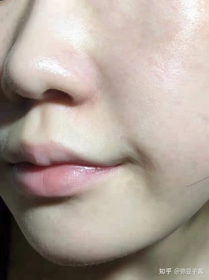 长痘痘吃什么会留痘印