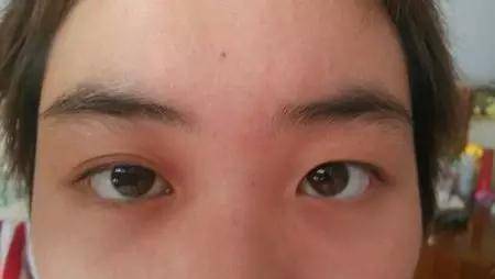 眼皮为什么一单一双