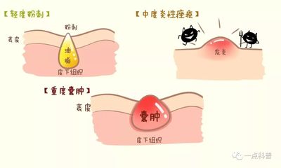 皮外囊肿怎么治疗