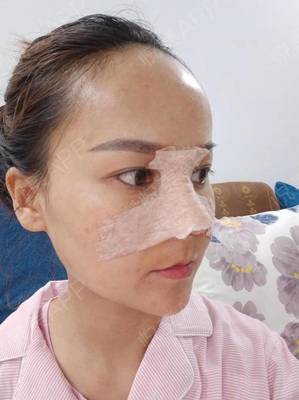 哪里自体隆鼻效果好