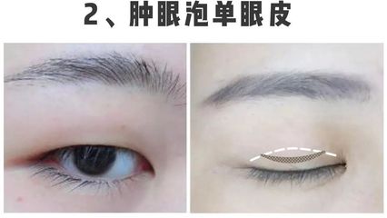 双眼皮就剩睫毛根部肿