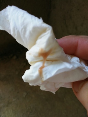 白带有点咖啡色是怎么回事