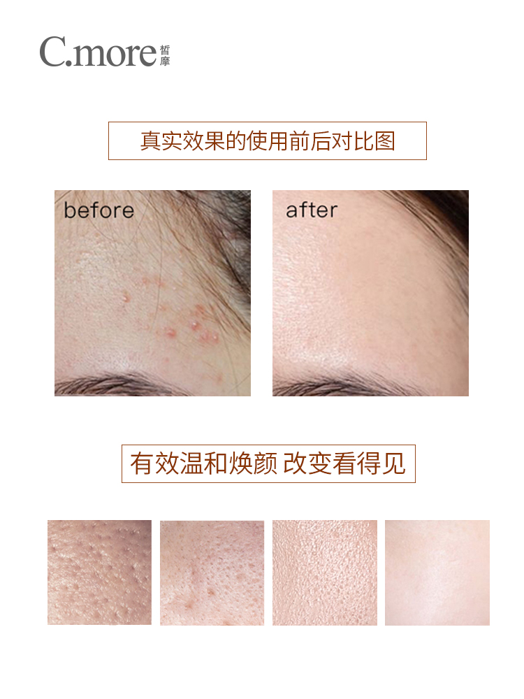 痘痘肌肤可以用精华液吗