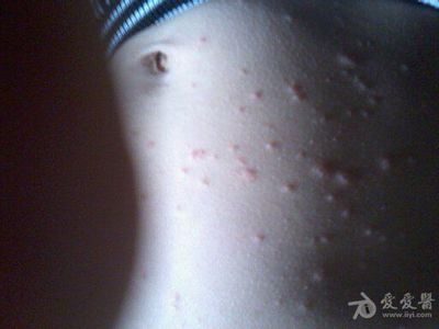 身上有皮疹是怎么回事