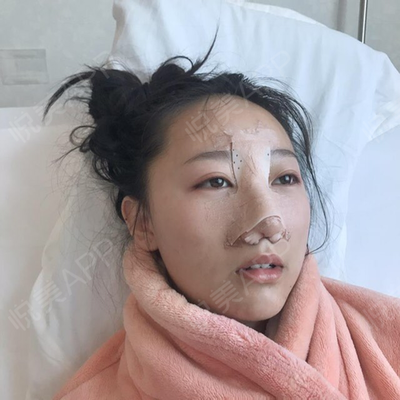 取耳软骨隆鼻疼吗