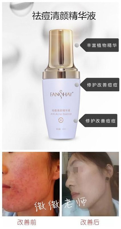 脸上有痘痘适合什么精华