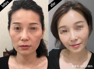 玻尿酸填充多久恢复自然
