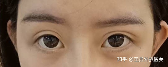 提肌双眼皮一般多少钱