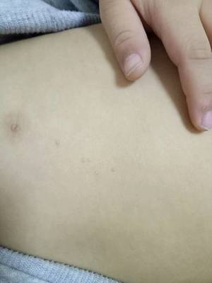 为什么前胸后背长粉刺