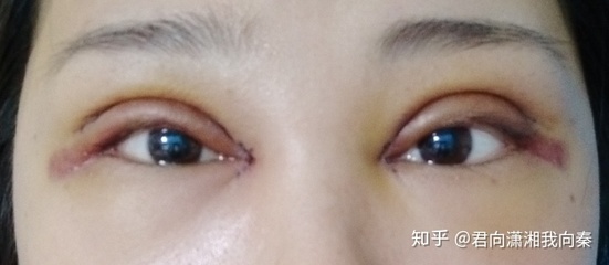 做梦割双眼皮什么意思