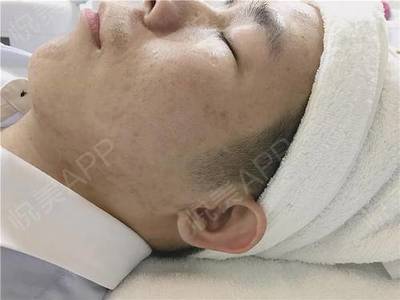 激光点痘痘