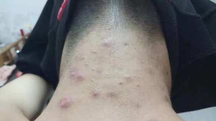 后脖子长了一个大痘痘