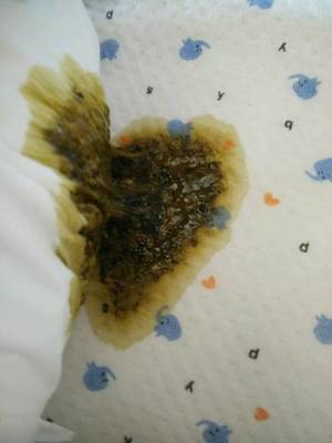 一岁宝宝拉黑色大便怎么回事