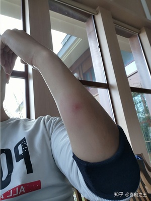 痘痘破了能鲜涂芦荟吗