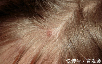 头上长痘痘是什么原因还掉头发