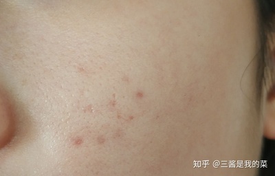 痘印变黑了还能好吗