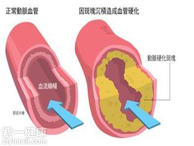 总胆固醇偏高怎么治疗