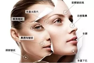 玻尿酸鼻唇沟多少钱