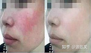红血丝皮肤用什么面膜
