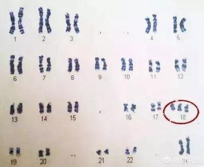 染色体会影响怀孕吗