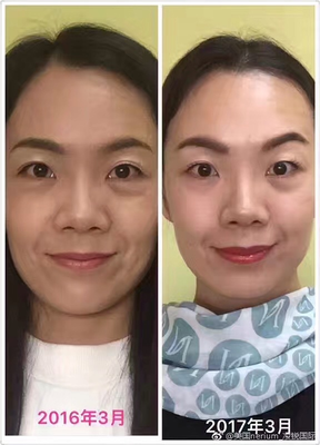 Ps除皱