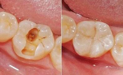 一般补牙需要多少钱