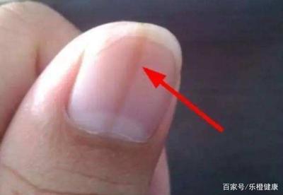 指甲有裂纹是怎么回事