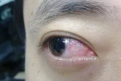 眼底发炎怎么治疗
