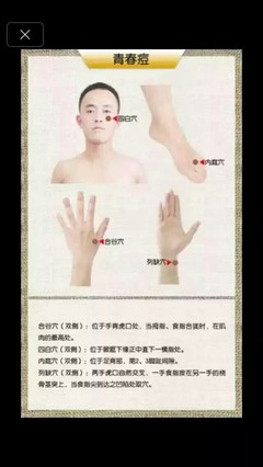 针灸治痘痘扎那个部位