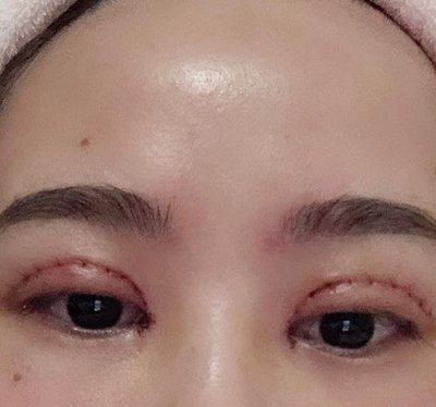 做双眼皮淤青多久能好