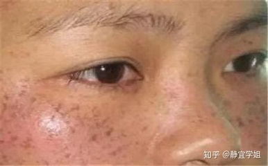 长痘痘可以挤吗