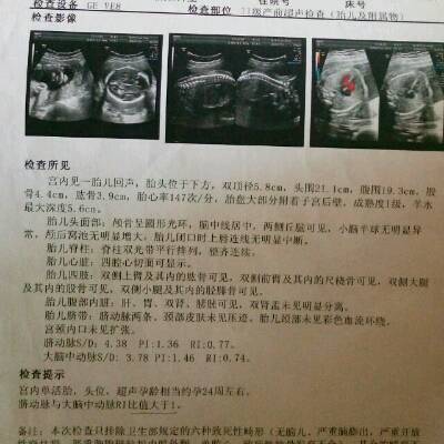 怎样检查胎儿是否缺氧