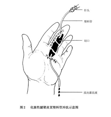 手指关节腱鞘囊肿怎么治疗