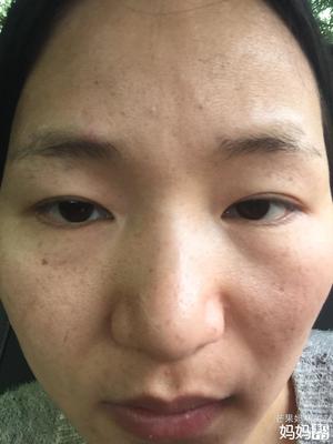 长痘痘吃什么会留痘印