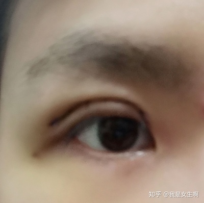 眼皮上长痘怎么办