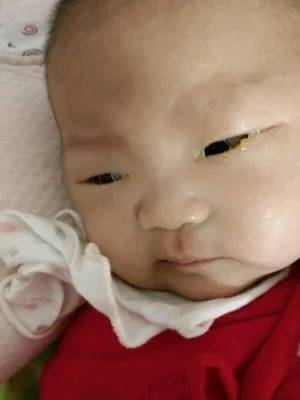 新生儿结膜炎的症状