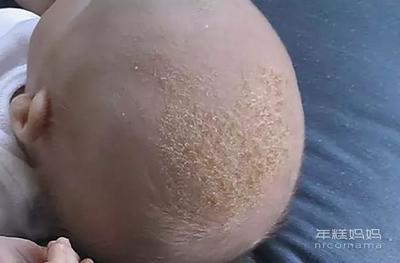 宝宝头皮上有结痂是怎么回事