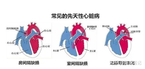 新生儿室间隔缺损