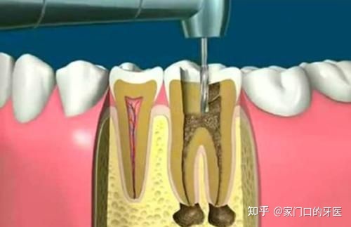 牙疼根管治疗是怎么治疗的