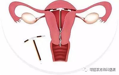 取环后是不是很难怀孕