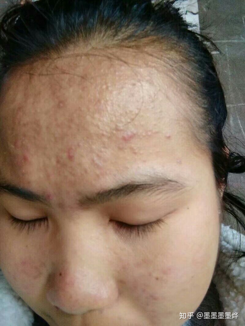 痘痘好了颜值确实提升不少